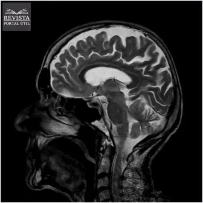 Como a radiologia pode ajudar no diagnóstico de Alzheimer