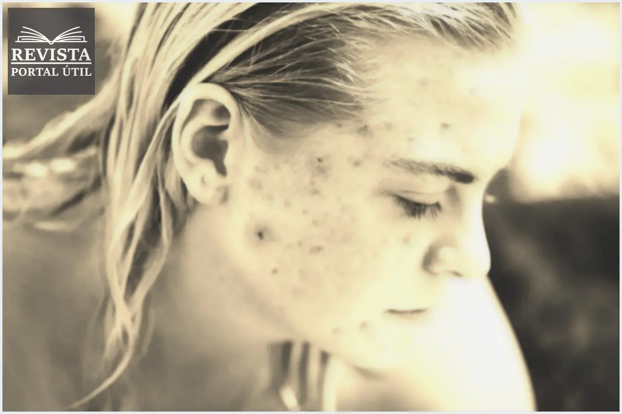 Acne depois dos 20: causas e como tratar Acne depois dos 20: causas e como tratar